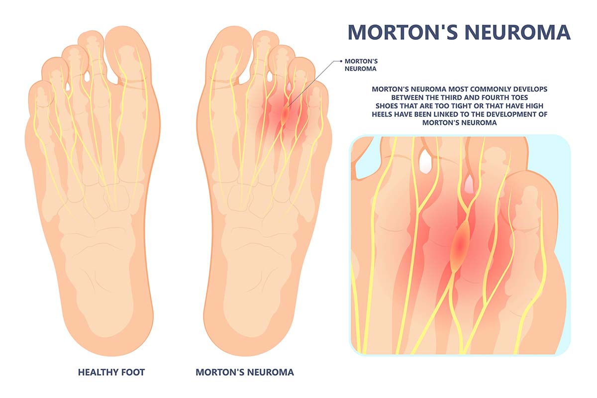 Morton Neurom Erklärung