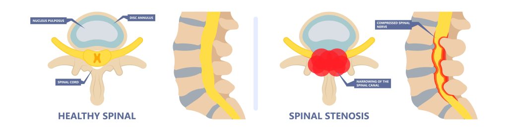 Grafik der Spinalkanalstenose